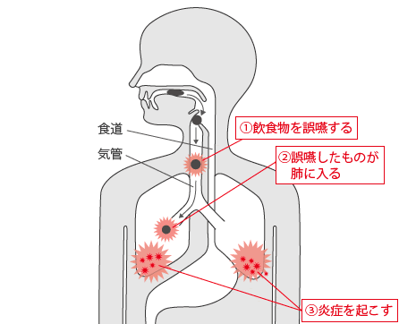 誤嚥の状態